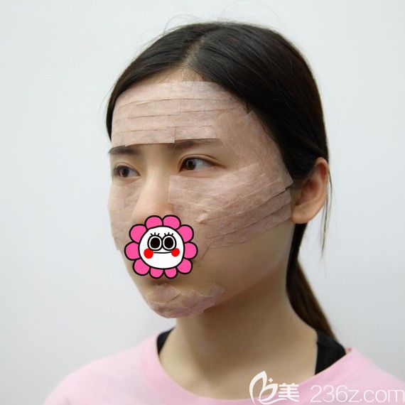 自体脂肪填充全脸术后即刻 自体脂肪填充全脸术后即刻