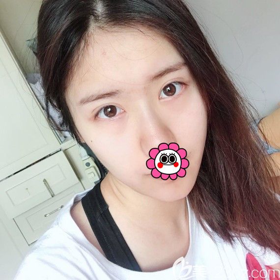 自体脂肪填充全脸术后五天 自体脂肪填充全脸术后五天