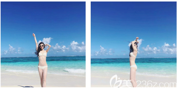 中信惠州医院整形科陈虹医生大腿吸脂案例 中信惠州医院整形科陈虹医生大腿吸脂案例