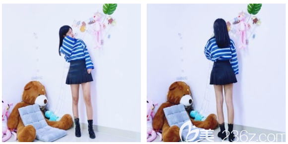 在中信惠州医院做完大腿吸脂一个月就见效了 在中信惠州医院做完大腿吸脂一个月就见效了