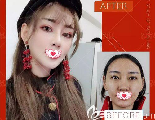 在昆明美伊莱整形找周诚做肋软骨隆鼻前后对比照