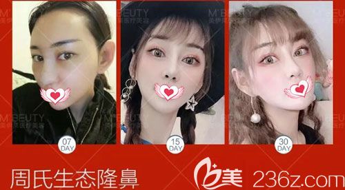 周诚院长做自体软骨隆鼻一个月的恢复过程图