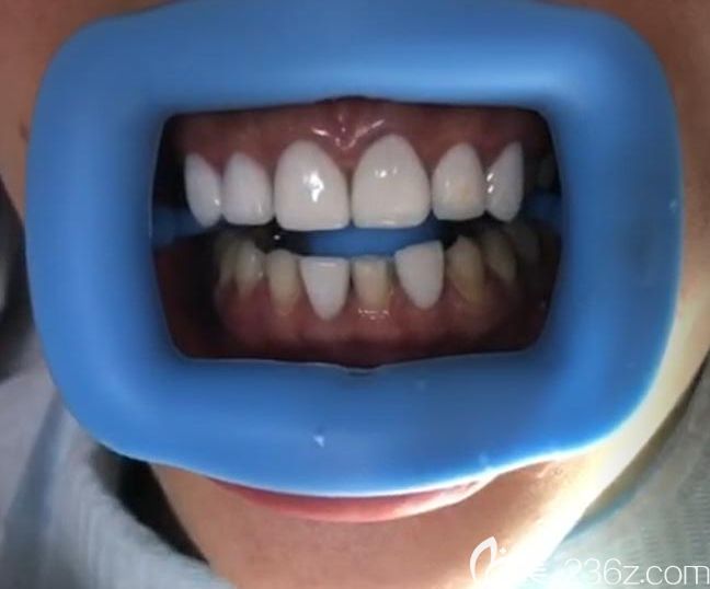 深圳质美口腔牙齿贴面真人案例