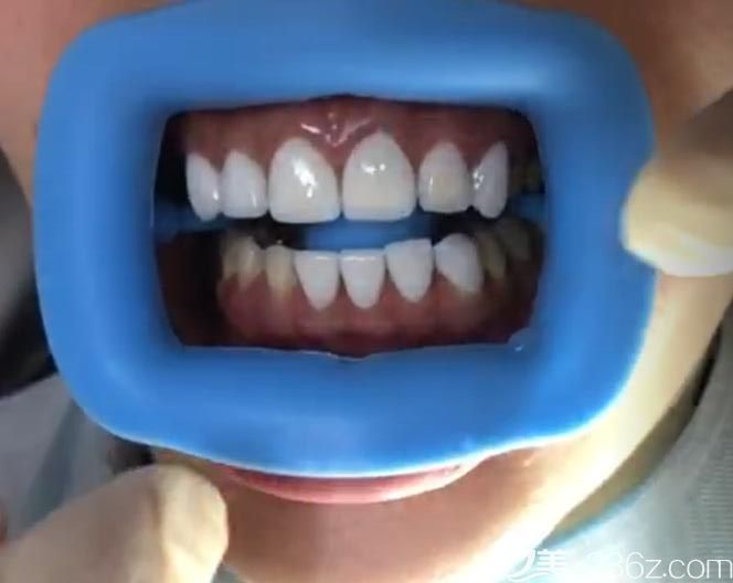 深圳质美口腔做美白牙齿贴面案例