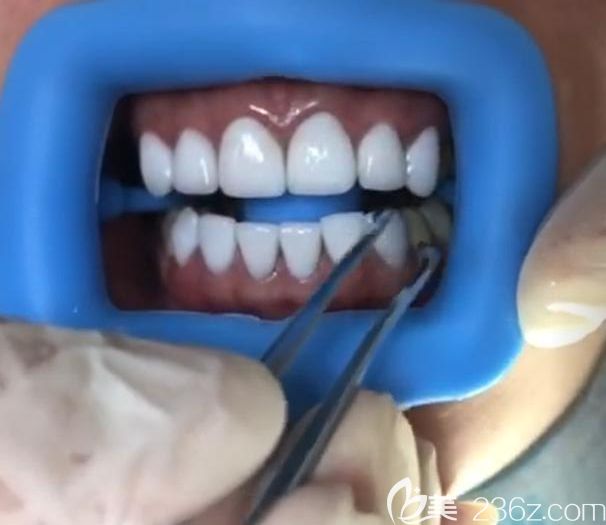  牙齿贴面案例 深圳质美口腔