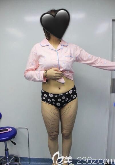 荆州华美肖升华大腿吸脂<span style= 荆州华美肖升华大腿吸脂<span style=