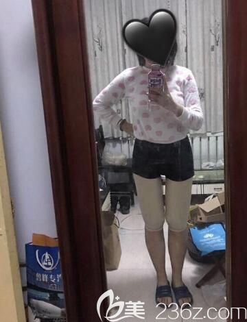 荆州华美大腿吸脂术后15天恢复图 荆州华美大腿吸脂术后15天恢复图