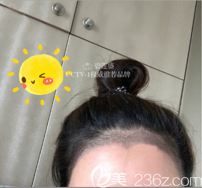 贺俊美人尖发际线种植一周效果