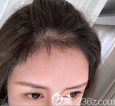 深圳碧莲盛贺俊发际线调整术后3个月