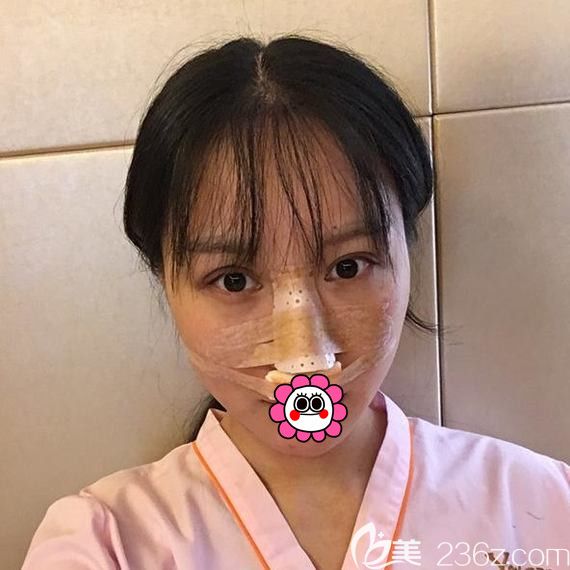 宁波艺星做鼻综合术后即刻
