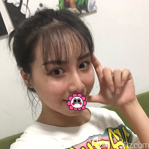 鼻综合七天拆线后