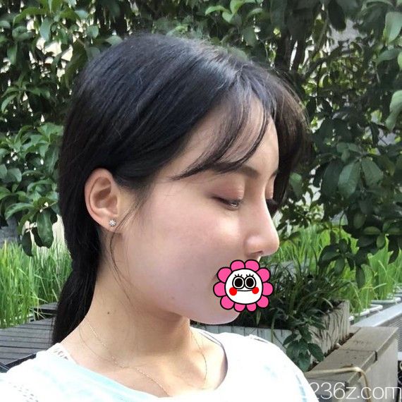 宁波艺星鼻综合效果怎么样