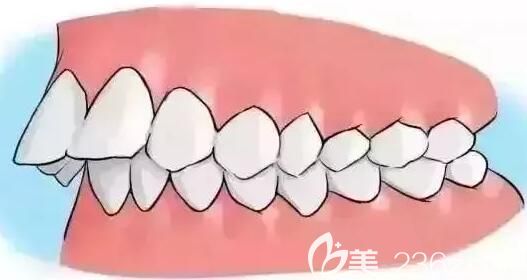 深圳格伦菲尔口腔员工做隐适美矫正龅牙 深圳格伦菲尔口腔员工做隐适美矫正龅牙