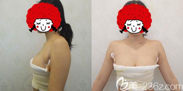 曼托毛面假体术后四天换药