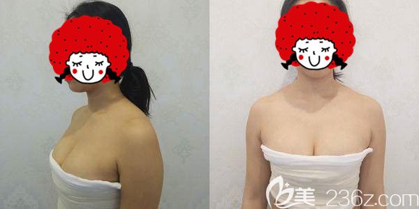 一周腋下拆线毛面曼托隆胸恢复中