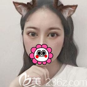 割双眼皮术后4天效果图