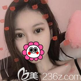 割双眼皮术后10天效果图