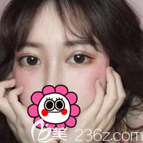 在长沙美之峰割双眼皮术后15天效果图
