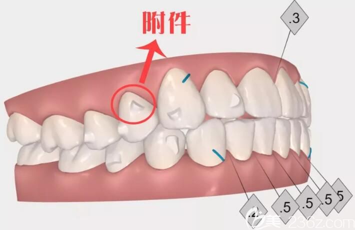 深圳格伦菲尔口腔隐适美矫正器附件 深圳格伦菲尔口腔隐适美矫正器附件