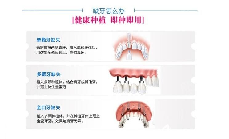 牙齿缺失修复方法图
