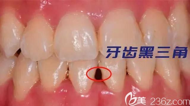 杭州齐尔口腔朱零教你预防牙套脸和黑三角 杭州齐尔口腔朱零教你预防牙套脸和黑三角