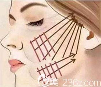 面部埋线提升可以改善皮肤下垂