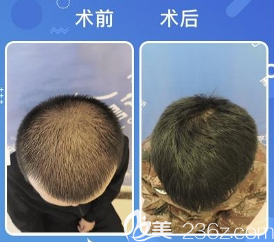 深圳碧莲盛BHT2.0头顶加密种植效果