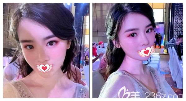 南宁爱思特超皮秒祛斑的术后效果图