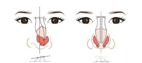 爱思特整形王楷做鼻子怎么样呢 爱思特整形王楷做鼻子怎么样呢