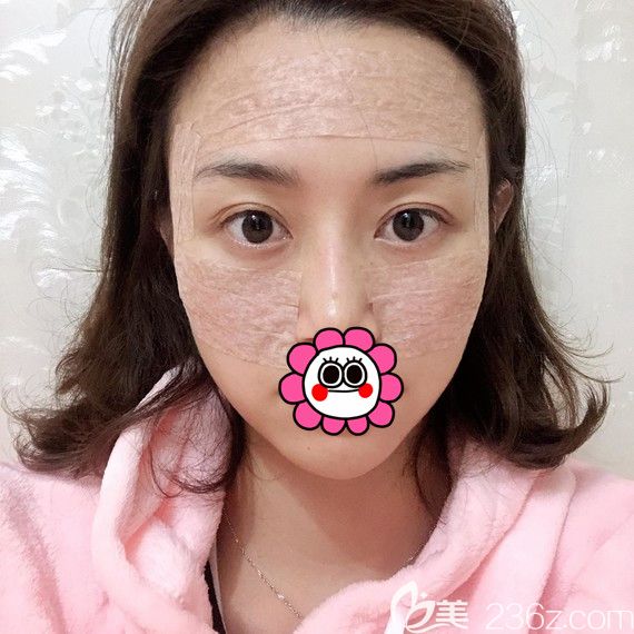 宁波薇琳做自体脂肪填充面部术后即刻