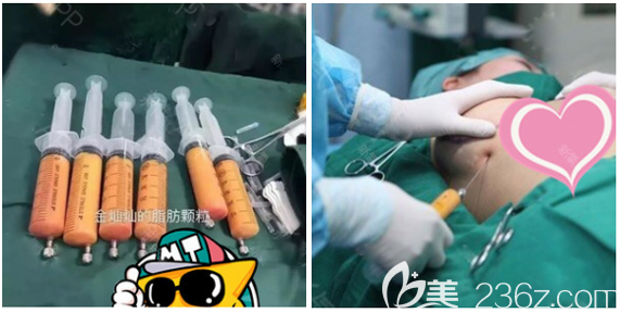 东莞壹加壹王挚隆胸手术过程图 东莞壹加壹王挚隆胸手术过程图