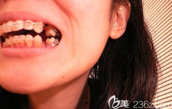 杨素医生解析：牙齿矫正拔牙利与弊