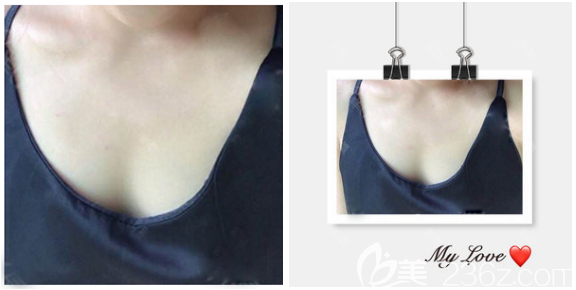 在东莞壹加壹整形医院隆胸术前照片 在东莞壹加壹整形医院隆胸术前照片