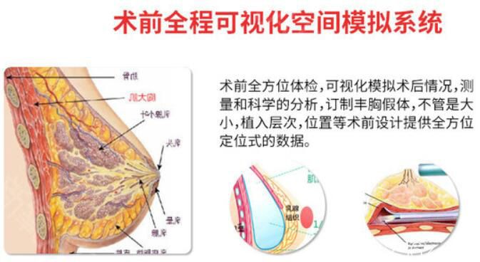 宁波薇琳曾举隆胸优势