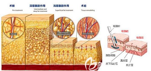 美兰德多维立体吸脂