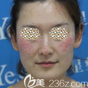 邵辉医生帮我做皮秒激光祛斑术后即刻 邵辉医生帮我做皮秒激光祛斑术后即刻