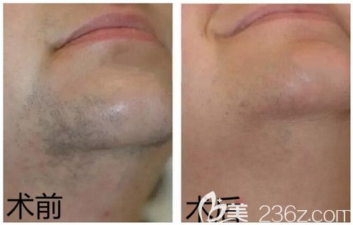 周口缔莱美冰点脱毛去胡子案例