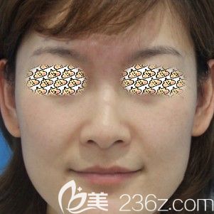 做皮秒激光术后15天红肿消除 做皮秒激光术后15天红肿消除