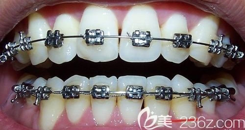 张猛医生讲解正畸中方弓丝和直弓丝及功能性矫治技术的区别 张猛医生讲解正畸中方弓丝和直弓丝及功能性矫治技术的区别