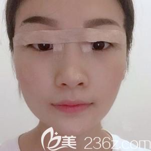 林勇完双眼皮术后<span style=