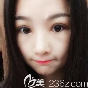 双眼皮术后恢复十天