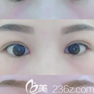 恢复二十天的双眼皮<span style=