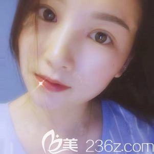 晒一下我在宁波壹加壹找林勇做的全切双眼皮一个月恢复过程图