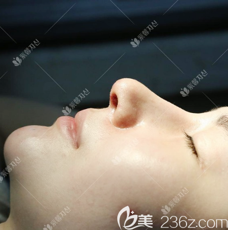 广州紫馨肋软骨隆鼻术后7天拆线效果图