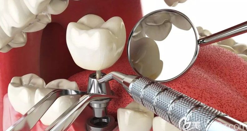 什么样的牙齿情况适合做即刻种植 什么样的牙齿情况适合做即刻种植