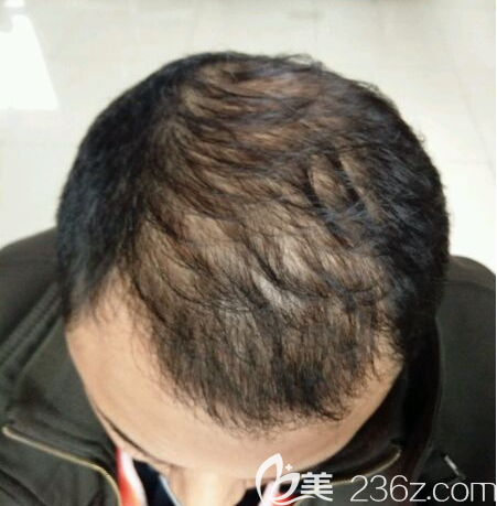 植发手术前的照片 植发手术前的照片