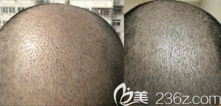 植发术后第5天和9天清洗血痂角质对比 植发术后第5天和9天清洗血痂角质对比