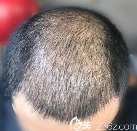 <!--<i data=20240703-sp></i>-->张桥植发案例一个月效果 <!--<i data=20240703-sp></i>-->张桥植发案例一个月效果