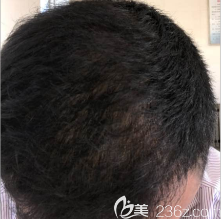<!--<i data=20240703-sp></i>-->植发4个月照片 <!--<i data=20240703-sp></i>-->植发4个月照片