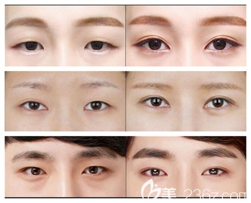 驻马店美兰德割双眼皮疗效图